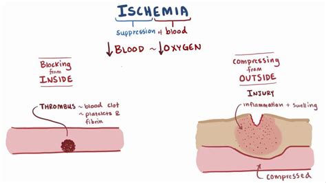 ischemia meaning in hindi